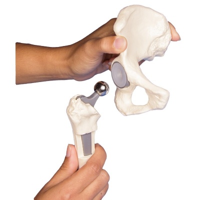 Hip Implant Model